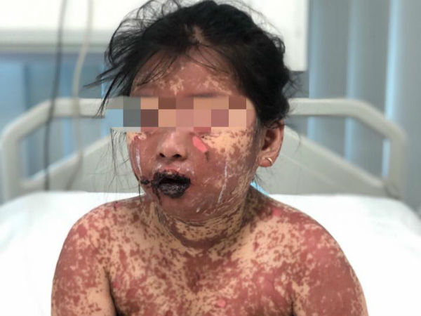 Dùng thuốc ở phòng khám tư, cháu bé 7 tuổi bị bỏng toàn thân