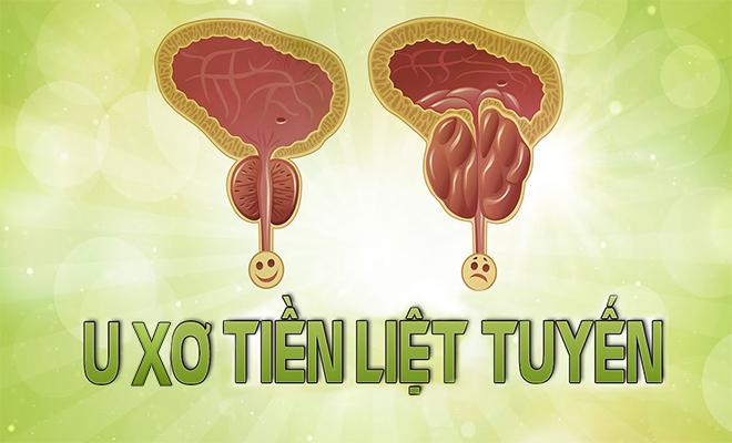 U xơ tiền liệt tuyến - chứng bệnh nam giới không bao giờ dám tiết lộ với các chị em