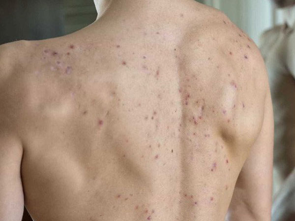 Mọc mụn trứng cá ở lưng là biểu hiện cho thấy cơ thể đang gặp vấn đề gì?