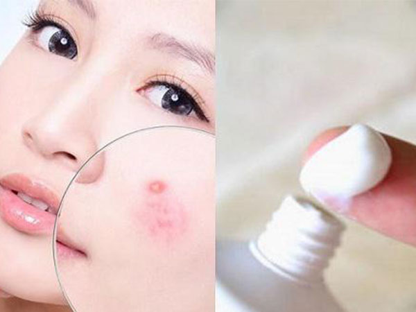 Bất ngờ trước cách trị mụn bọc chẳng tốn bao nhiêu tiền với kem đánh răng!