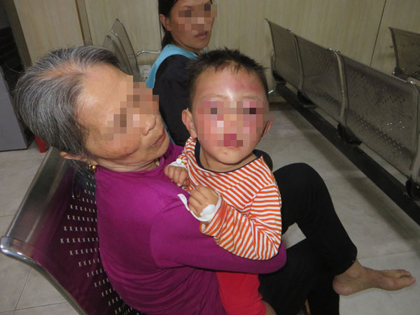 Nghệ An: Nghi vấn bé trai 2 tuổi bị cha dượng bạo hành khiến mặt mũi sưng phù, bầm tím