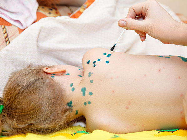 Bệnh thủy đậu và những điều cần biết