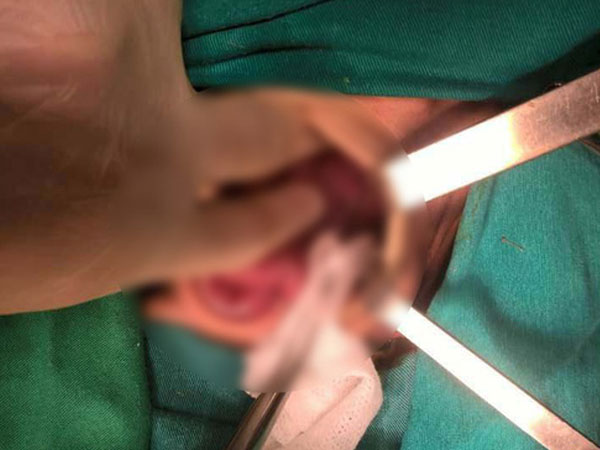 Lào Cai: Cứu sống bé sơ sinh nặng 1,7kg bị vỡ dạ dày
