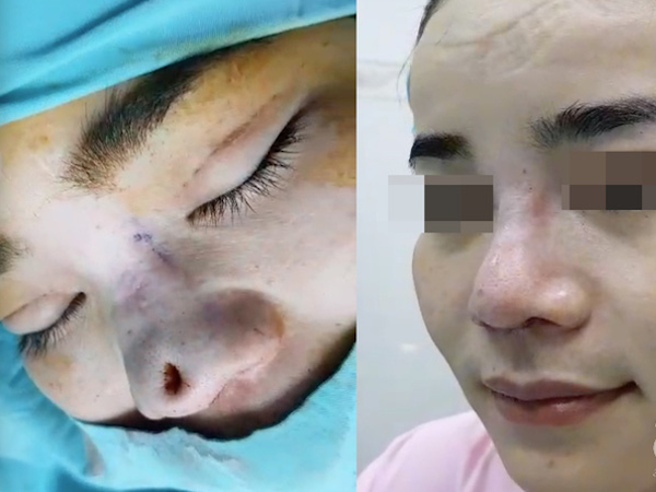 Cô gái 22 tuổi ở Bạc Liêu bị hủy hoại dung nhan vì đi nâng mũi bằng chỉ