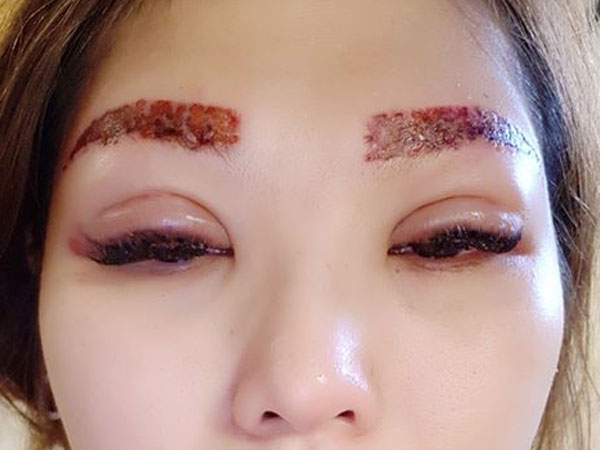Muốn xăm mí mắt, lông mày cho giống Hồ Ngọc Hà, ai ngờ bị hỏng, cô gái lại chịu bao đau đớn để xóa xăm