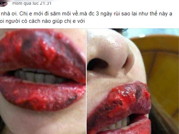 Ham xăm môi căng mọng, cô gái trẻ nước mắt hai hàng nhìn đôi môi sưng tều, 'cháy sém' như quả táo héo