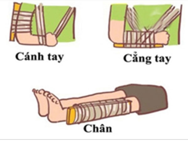 Hướng dẫn sơ cứu đúng cách cho trẻ bị gãy xương