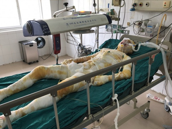 Cô gái bị người yêu tẩm xăng thiêu sống ở Vĩnh Phúc đã qua đời