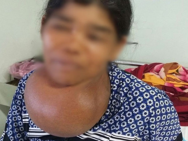 Người phụ nữ mang khối bướu 'khổng lồ' ở cổ suốt 35 năm