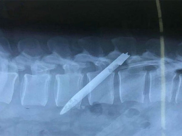 Lưỡi dao 13cm ‘ngủ quên’ ở lưng chiến sĩ công an suốt 11 năm
