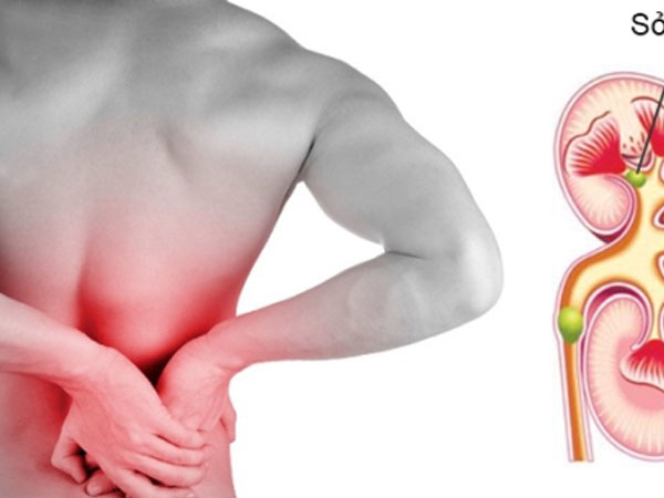 Sỏi thận nguy hiểm thế nào