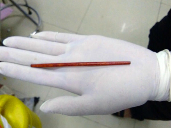 Gắp chiếc đũa dài hơn 10cm ra khỏi dương vật
