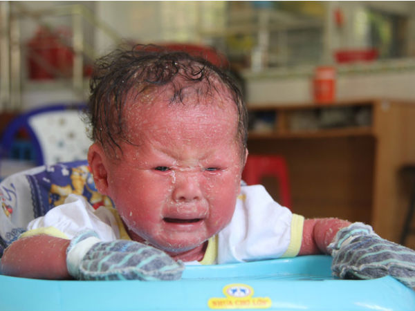 Người đầy vẩy ngứa như da trăn, bé gái 14 tháng tuổi bị bố mẹ bỏ rơi nên không có tiền chữa trị