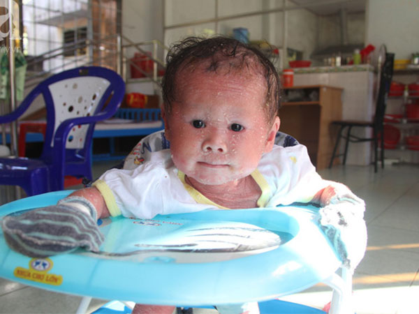 Phép màu kỳ diệu đã đến với bé gái 14 tháng tuổi người đầy vẩy ngứa như da trăn