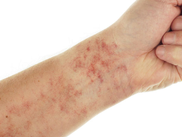 12 dấu hiệu cảnh báo bệnh lupus ban đỏ
