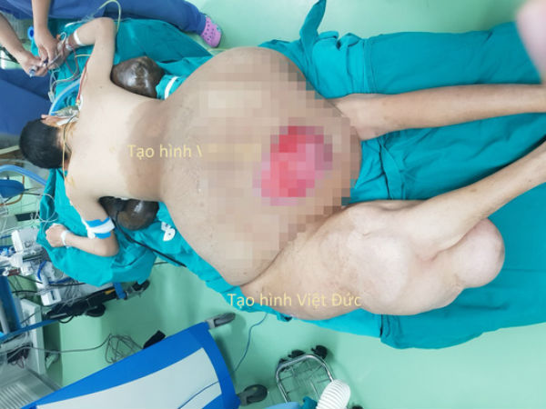 Bác sĩ 'choáng' với khối u nặng 45 kg trên người nam thanh niên