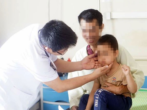Bé trai 5 tuổi mọc ria mép do lạm dụng corticoid