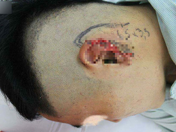 Hà Nội: Thanh niên ngồi nhậu bị bạn nhậu cắt đứt tai
