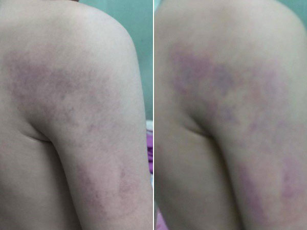 Kỷ luật cảnh cáo cô giáo đánh bầm tím học sinh lớp 1 vì trình bày bài không trôi chảy