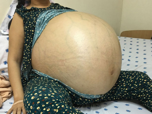 6 giờ ròng rã cứu mạng người phụ nữ mang khối u buồng trứng lớn nhất Việt Nam