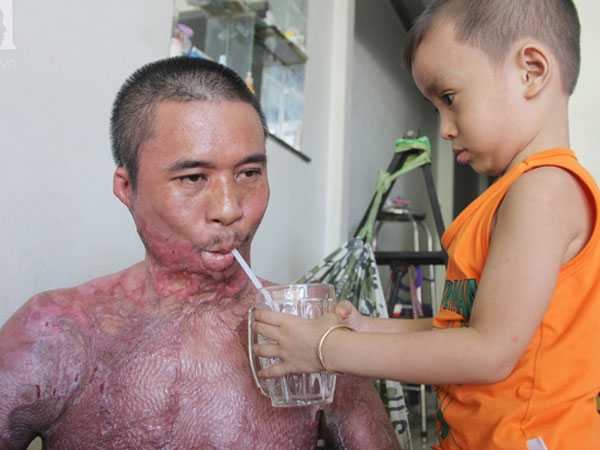 Bị điện giật cháy người không có tiền chạy chữa, bố xót xa nhìn con trai 4 tuổi không nhận ra mình