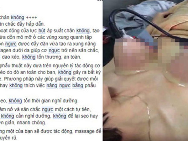 Nâng ngực bằng máy hút chân không: Trò lừa bịp của các cơ sở làm đẹp
