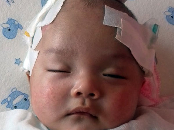 Tiếng khóc xé lòng của bé trai hơn 5 tháng tuổi mắc bệnh não úng thủy