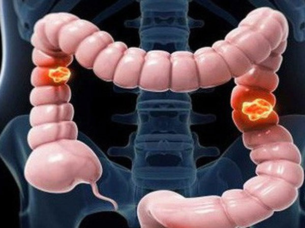 8 người trong một gia đình Tuyên Quang bị ung thư đại tràng