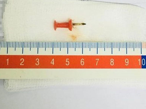 Phát hiện đinh ghim sắt trong phế quản bé gái 12 tuổi
