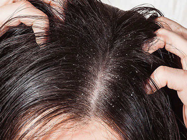 Xử lý khi bị nấm da đầu, tránh khó chịu, ngứa ngáy, mất tự tin vào mùa hè