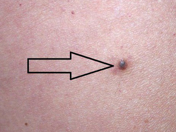 Chuyên gia hướng dẫn cách kiểm tra nốt ruồi trên cơ thể có khả năng gây ung thư hay không