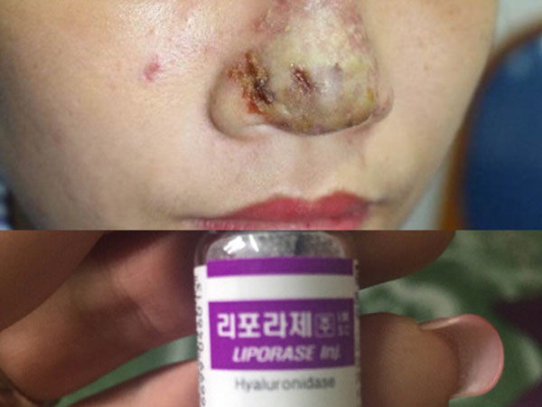 Cô gái 23 tuổi bị hoại tử mũi sau tiêm filler tại một spa
