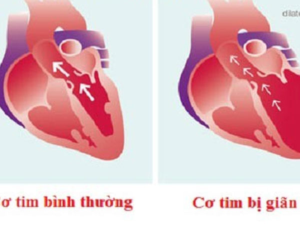 Căn bệnh nào được xem là 'ung thư của tim'?