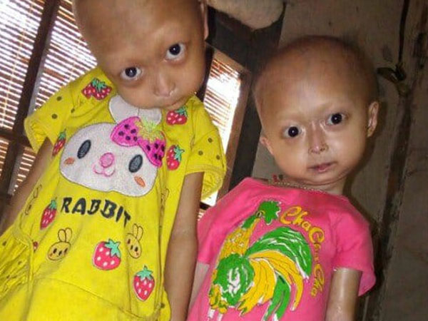 Tuyên Quang: 2 chị em gái mắc bệnh lạ khiến đầu, cổ bị nghẹo tựa 'người ngoài hành tinh' khiến ai nhìn cũng xót xa