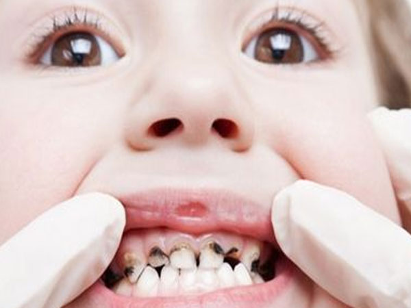 Cách ngăn ngừa và điều trị sâu răng hiệu quả