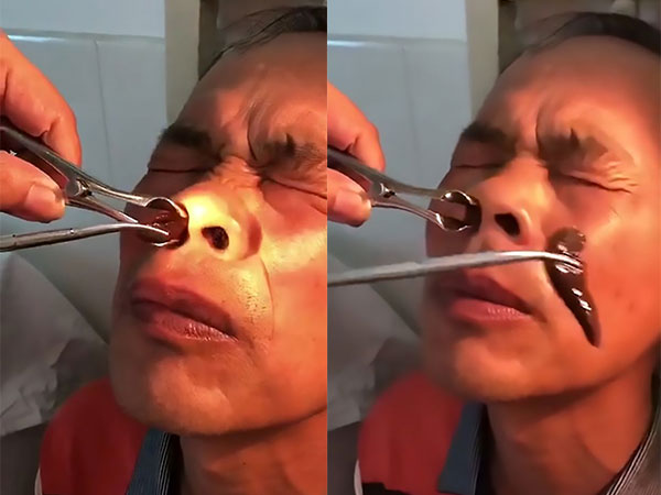 Hãi hùng cảnh lôi đỉa khổng lồ khỏi mũi bệnh nhân