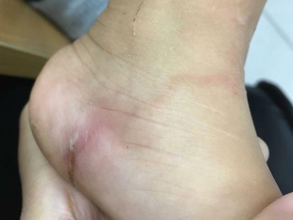 Về quê chơi dịp hè, bố kinh hãi phát hiện con gái 5 tuổi bị giun xâm nhập cơ thể, bò lúc nhúc dưới da