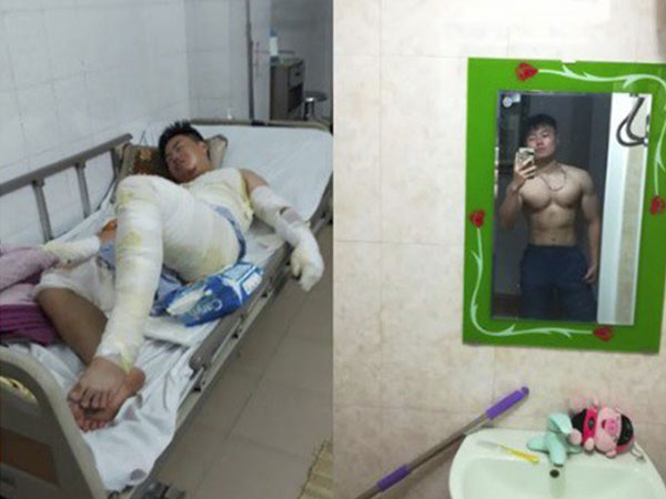 Hành trình phục hồi từ cơ thể bị bỏng nặng 40% đến body cơ bắp khỏe mạnh của chàng trai Thái Nguyên