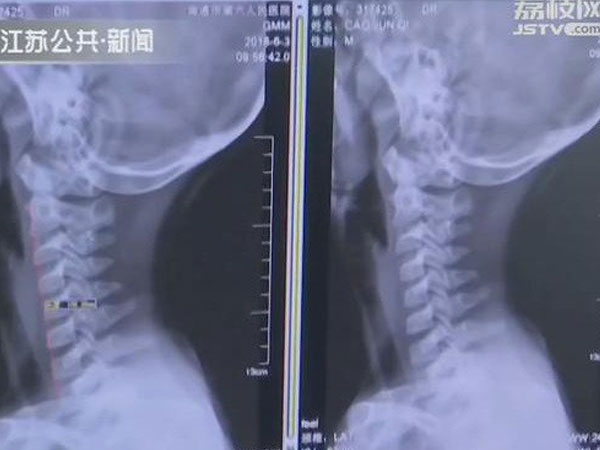 Cảnh báo: Bé 9 tuổi biến dạng xương cổ do xem điện thoại, cha mẹ phát hiện thì đã quá muộn