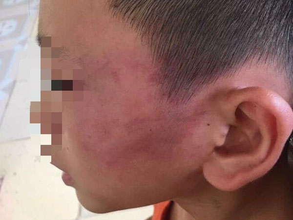 Nghệ An: Nghi án bé trai 12 tuổi bị mẹ kế đánh thương tích đầy mình phải nhập viện