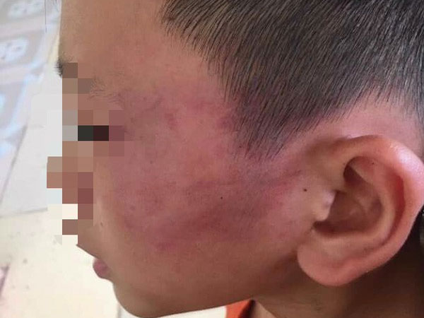 Bé trai 12 tuổi nghi bị mẹ kế đánh nhập viện ở Nghệ An: Mẹ kế là giáo viên, 'do bé ăn nói hỗn láo nên mới dạy'