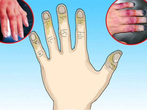 Bỏng lạnh cực nguy hiểm nếu không được sơ cứu đúng cách nhưng mọi người vẫn chưa nâng cao cảnh giác