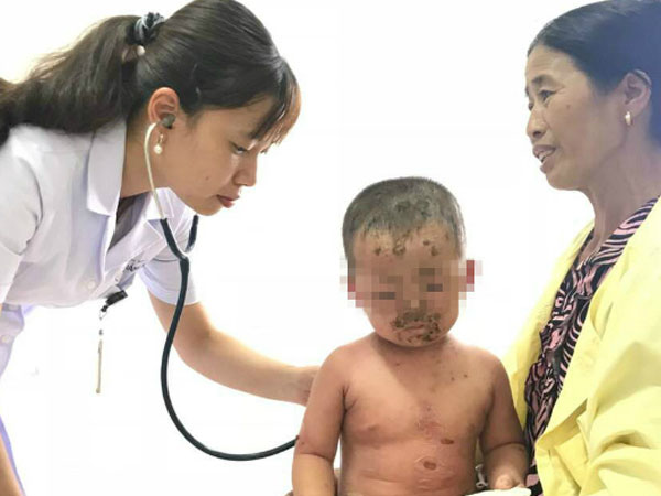 Bé 2 tuổi bị loét mặt do tắm nước lá