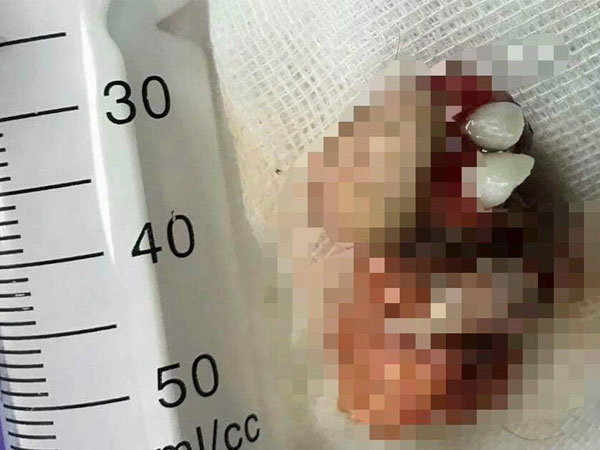 Khối u mọc răng, tóc trong buồng trứng bé gái