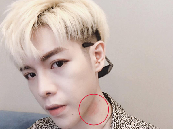 Bị dấu đỏ bất thường nghi là 'vết tích' của người yêu trên cổ, Đức Phúc 'khóc dở mếu dở' giải thích với fan
