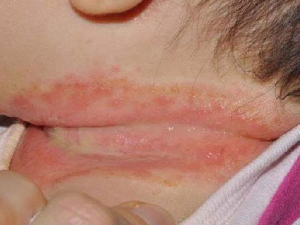 Sai lầm khi chữa rôm sẩy cho trẻ nhiều phụ huynh hay mắc phải