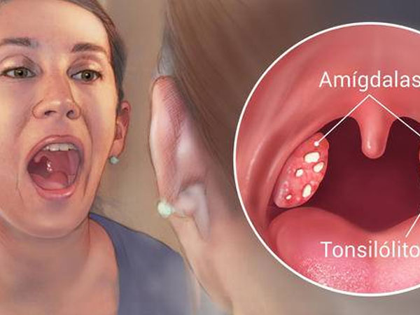 Viêm amidan hốc mủ là bệnh gì? Liệu bạn đã biết rõ