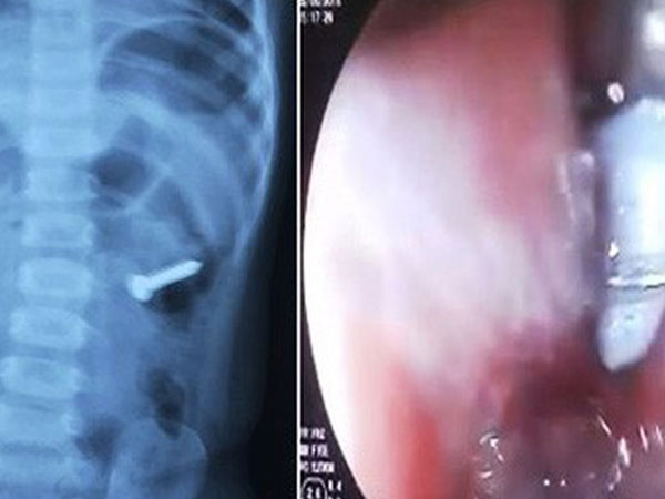 Bé 2 tuổi suýt mất mạng vì nuốt phải đinh ốc xoắn dài 3cm vào bụng