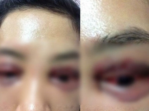 Nguyên ĐB Q­­uốc hội qua đời sau làm đẹp: Nguy cơ sốc phản vệ do thẩm mỹ