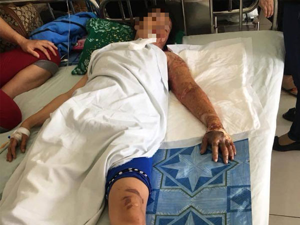 Đồng Tháp: Bị người tình phát hiện có vợ con nên đòi chia tay, gã đàn ông mua xăng về phóng hỏa khiến 3 người nhập viện